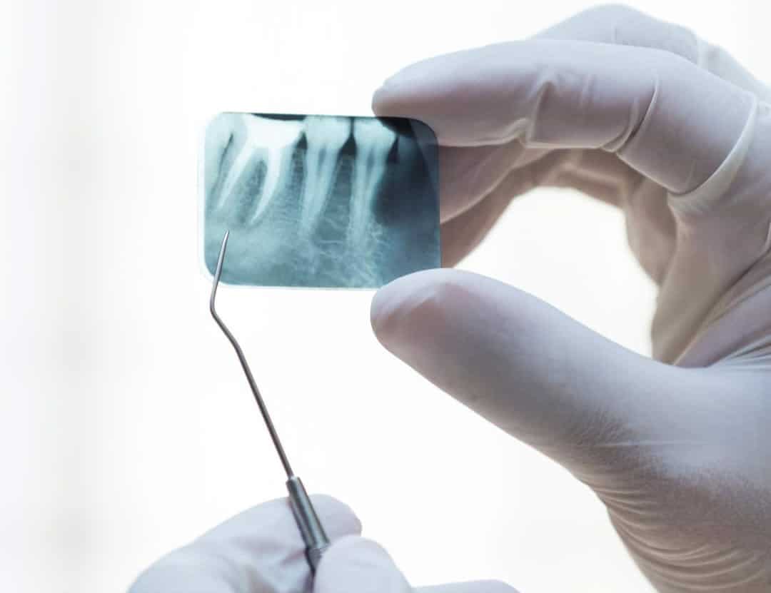 Tooth x-ray being examined by a dentist at Kelly Family Dentistry