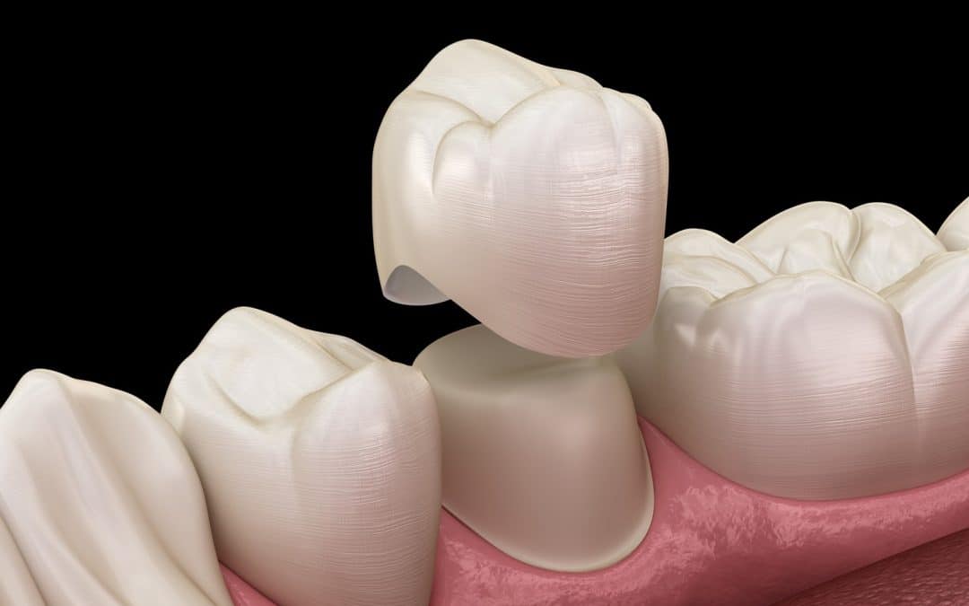 Dental crown at Kelly Family Dentistry in Franklin TN
